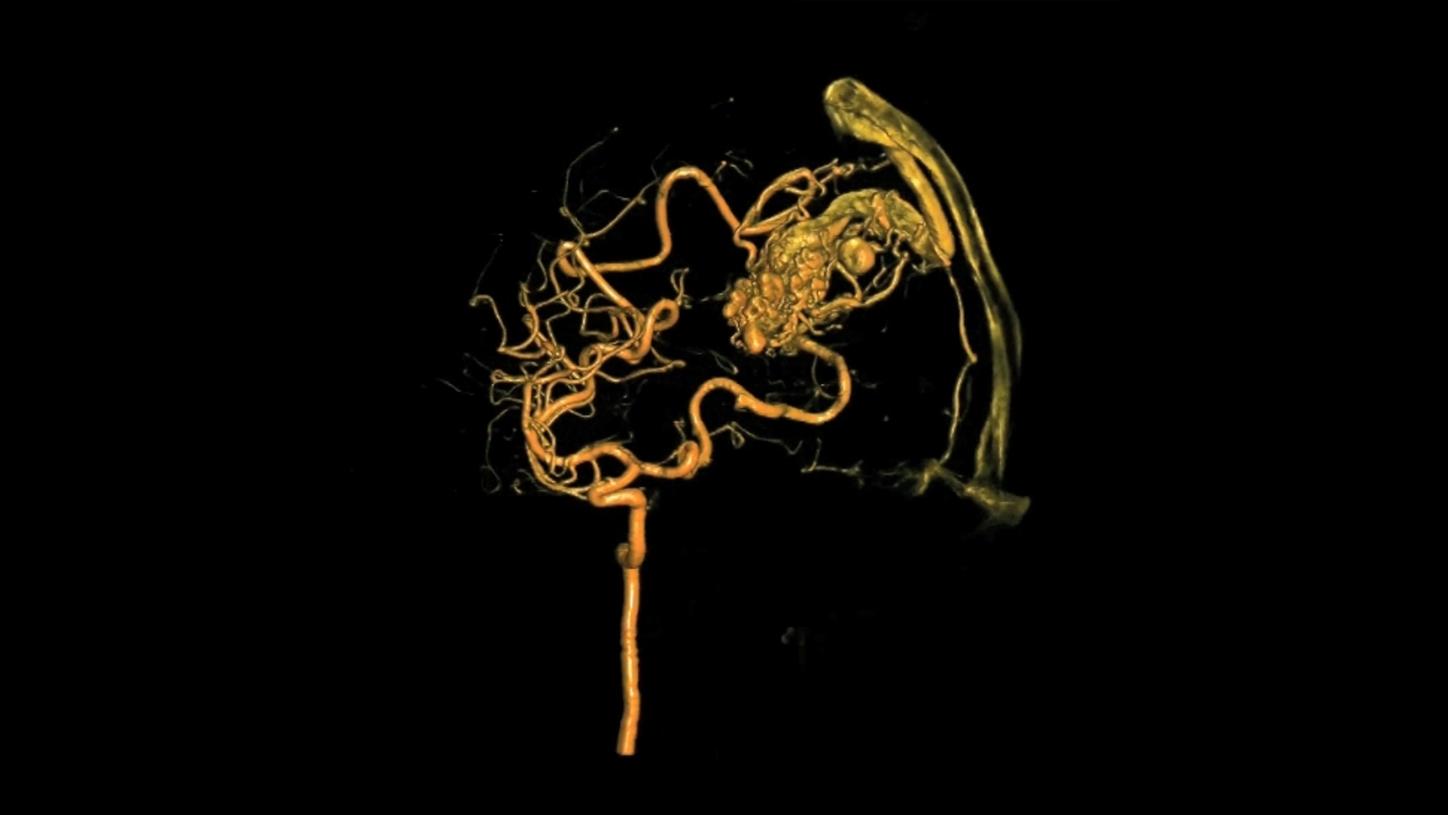 syngo_Dyna4D_3_Angiography_1800000006833238
